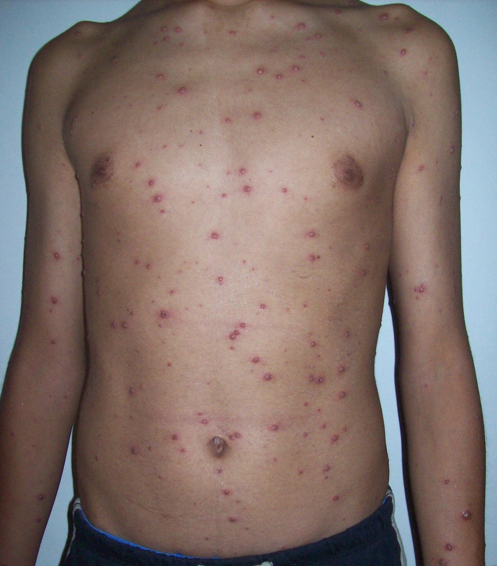 What Is Chickenpox?